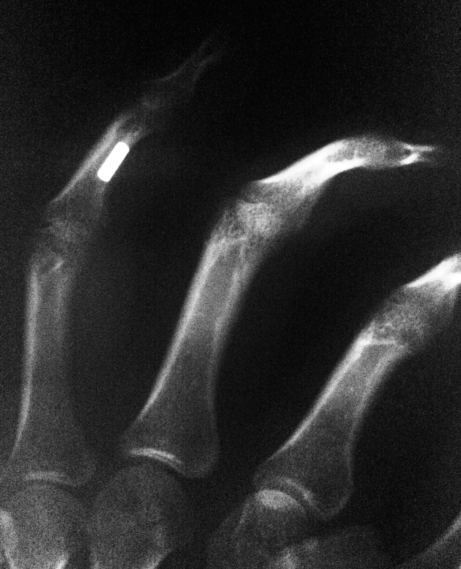 X-Ray of the magnet in my finger